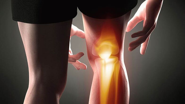 Arthrose de l'articulation du genou